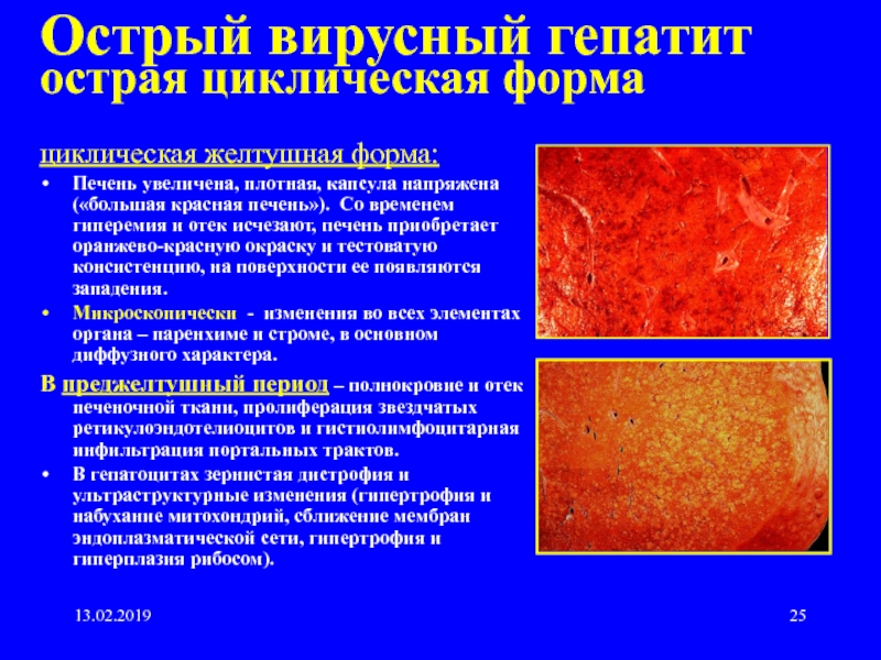 Вирусный гепатит желтушный период
