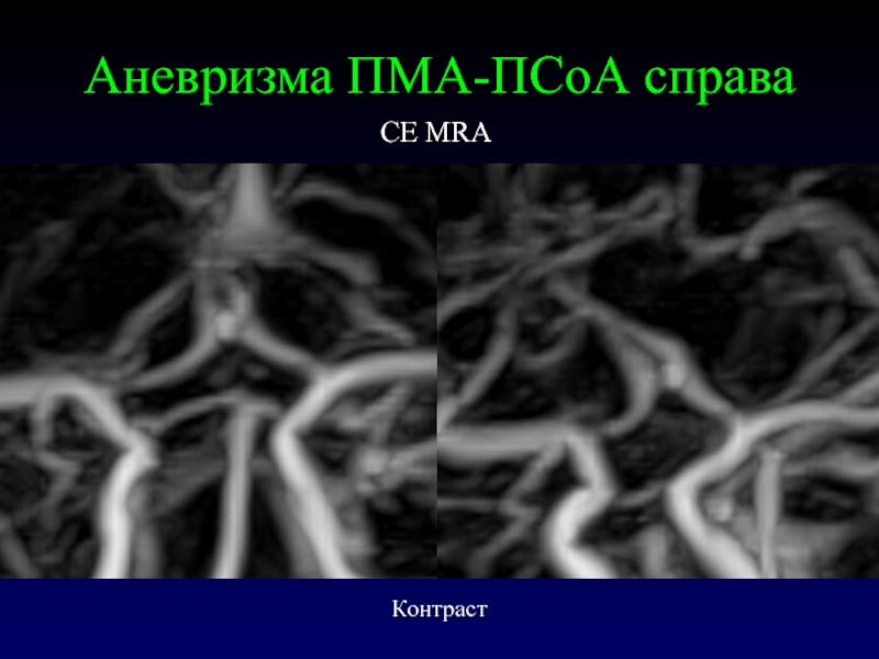 Сегмент а1 пма. Аневризма передней мозговой артерии кт. ПМА пса расшифровка аневризма.