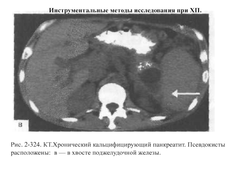 Псевдокиста поджелудочной железы. Кальцифицирующий панкреатит кт. Псевдокиста поджелудочной железы кт. Инфицированная псевдокиста поджелудочной железы на кт. Псевдокиста поджелудочной железы кт кт.