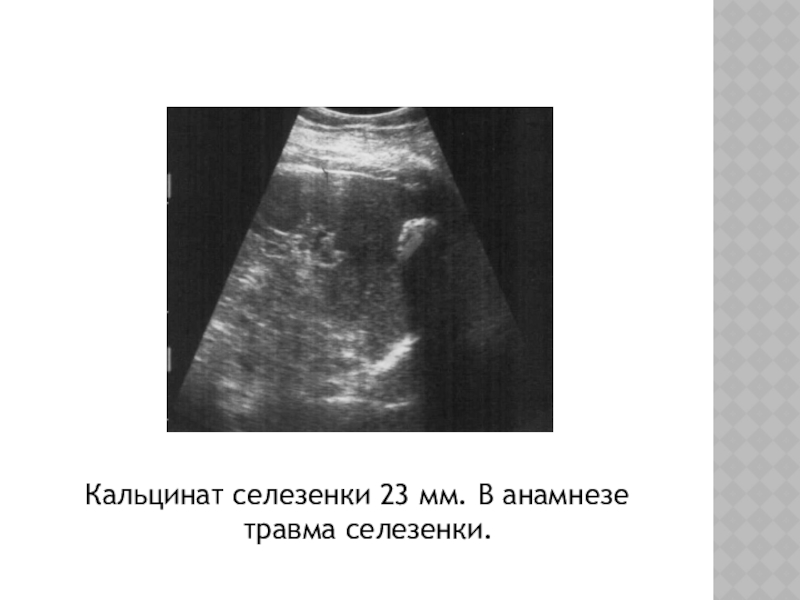 Травмы селезенки презентация