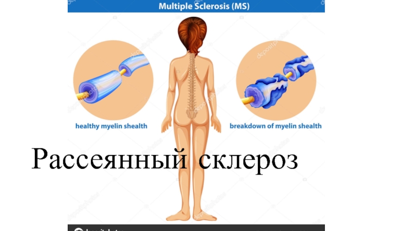 Шашыранды склероз презентация