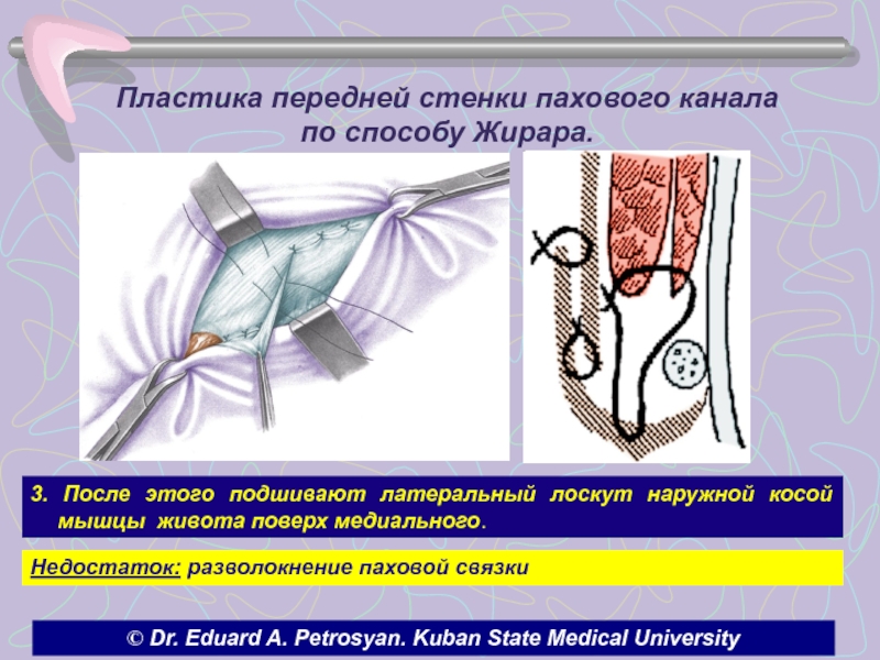 Пластика при прямых паховых грыжах