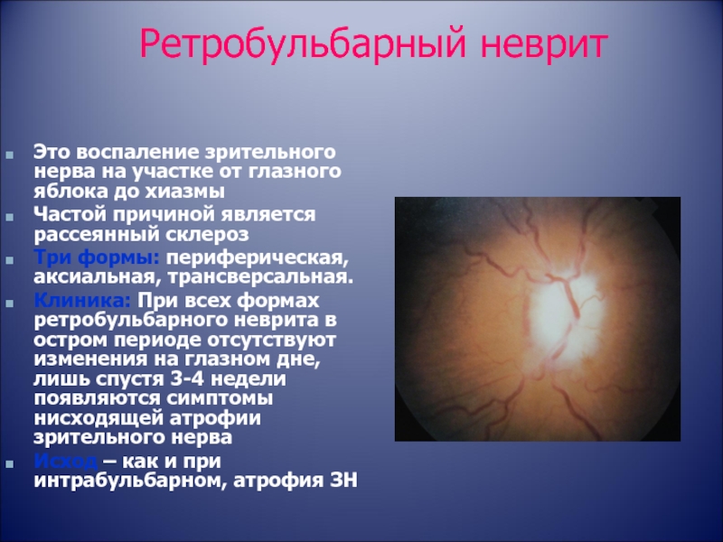 Лечение глазного нерва. Клиника ретробульбарного неврита зрительного нерва. Ретробульбарный неврит глазное дно. Неврит зрительного нерва глазное дно. Ретробульбарный неврит (папиллит).