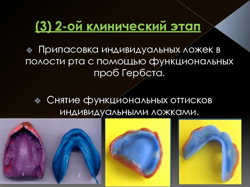 Припасовка индивидуальной ложки на верхней челюсти проводят по следующему плану