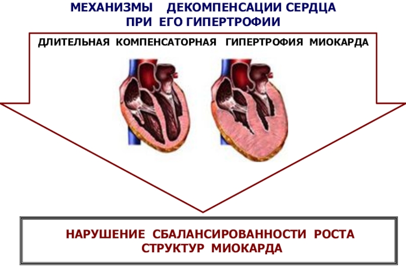 Гипертрофия миокарда рисунок