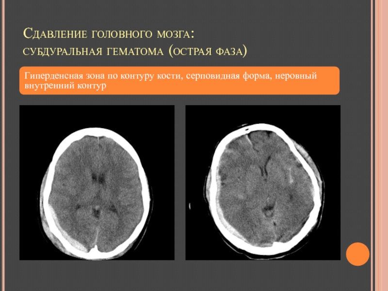 Сдавление головного мозга гематомой. Субдуральная гематома головного мозга кт. Субдуральные гематомы на кт. Эпи субдуральная гематома кт. Кт картина субдуральной гематомы.