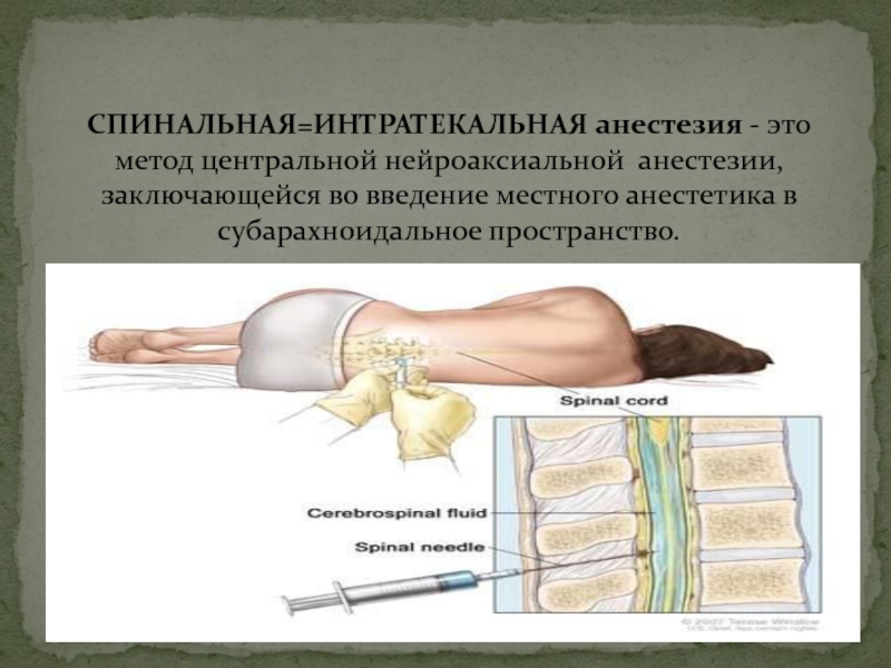 Спинномозговая анестезия презентация