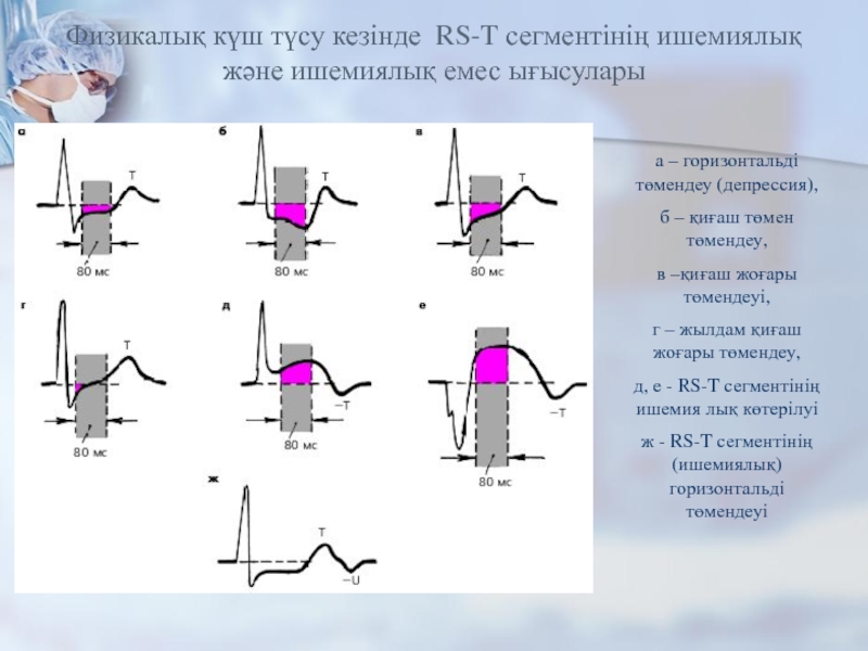 Физикалық күш түсу кезінде RS-T сегментінің ишемиялық және ишемиялық емес ығысуларыа – горизонтальді төмендеу (депрессия), б –