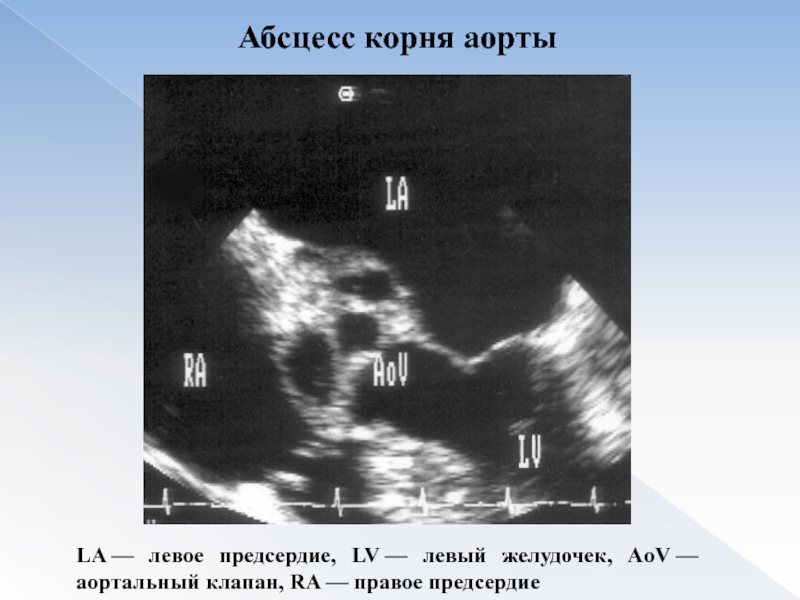 Уплотнение аорты сердца на узи