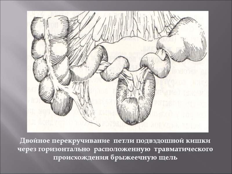 Расширение петель кишечника. Дистальная петля подвздошной кишки. Петли подвздошной кишки расположены. Петли подвздошной кишки располагаются:.