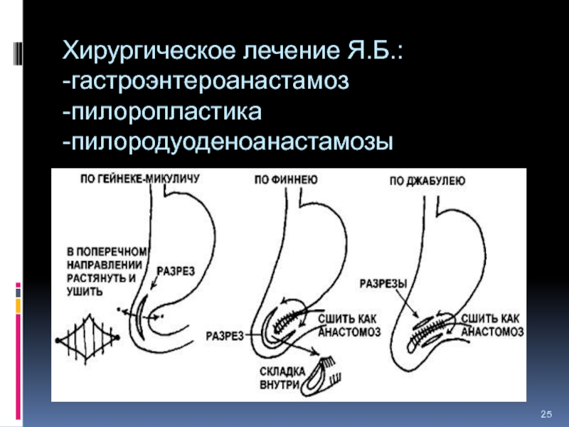 Пилоропластика по финнею схема