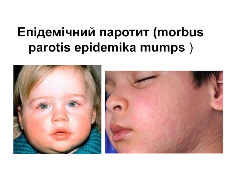 Епідемічний паротит ( morbus parotis epidemika mumps )