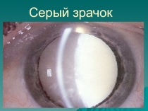 Серый зрачок