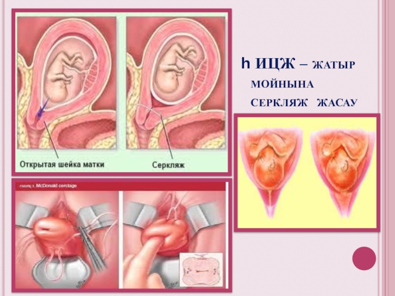 Цервикальный серкляж. Лапароскопический серкляж шейки матки.