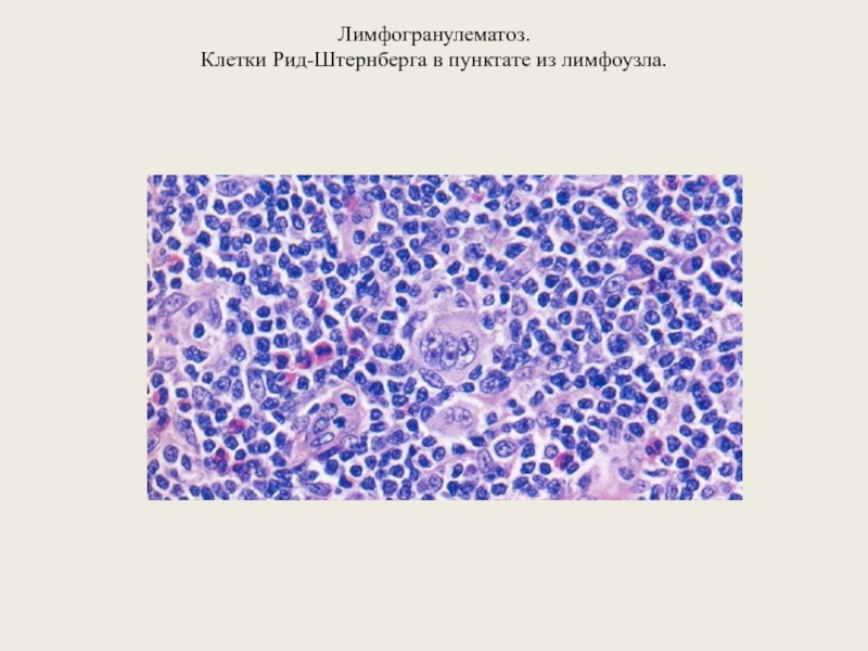 Клетки рида штернберга. Клетки Березовского-Штернберга. Лимфогранулематоз гистология. Лимфома Ходжкина лимфоузел микропрепарат.