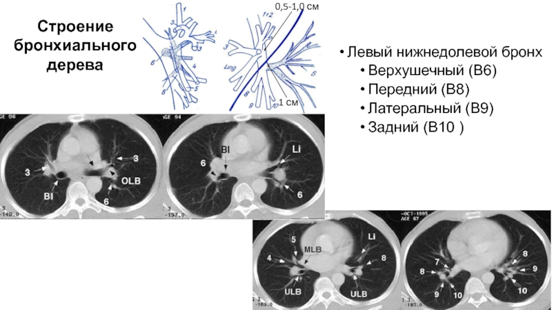 Бронхи на кт схема