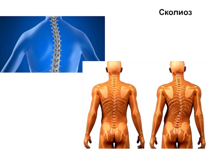 Психосоматика сколиоза. Сколиотическая болезнь травматология. Заболевание опорно-двигательной системы.сколиоз. Сколиотическая болезнь травматология презентация.