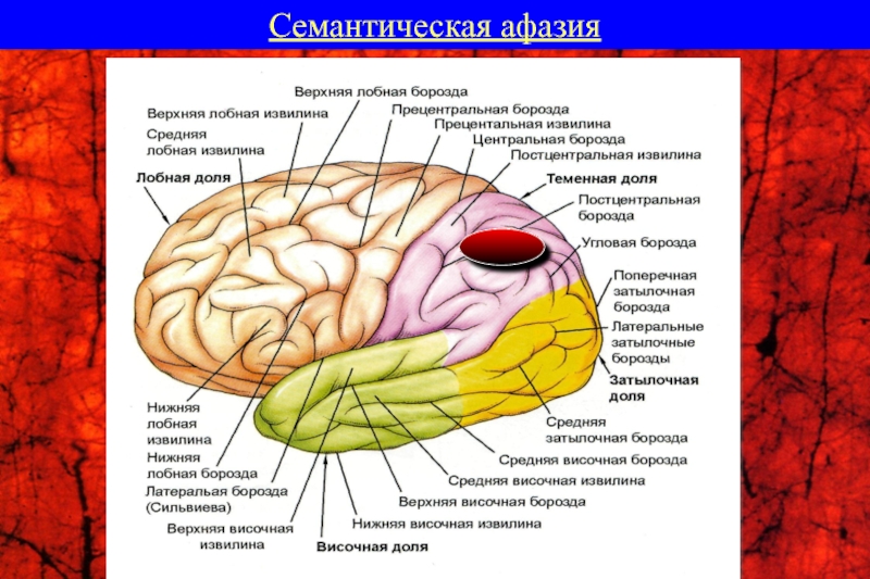 Семантическая афазия клиническая картина