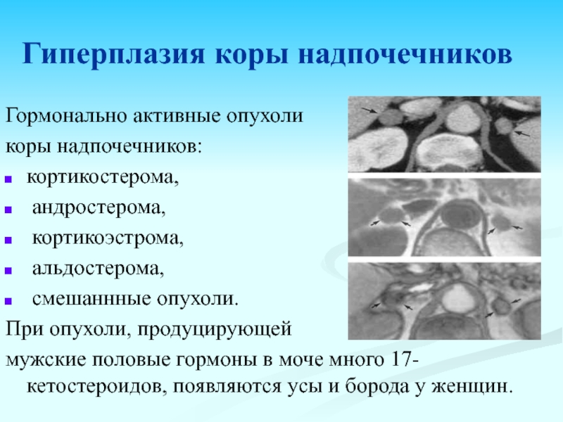 Узелковая гиперплазия надпочечника