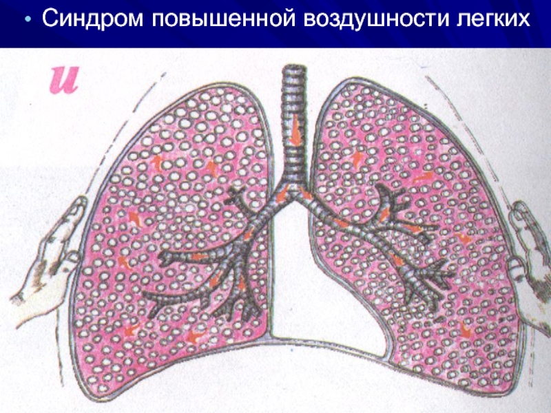 Синдром повышенной воздушности легочной. Синдром повышенной воздушности легочной ткани пропедевтика. Повышение воздушности легочной ткани. Повышенная воздушность лёгких это. Эмфизема патогенез.