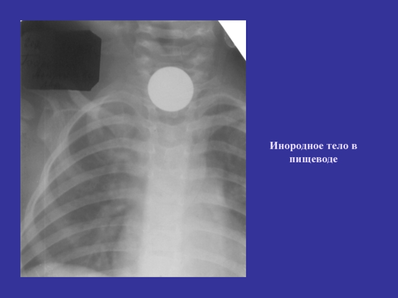 Лучевая диагностика пищевода презентация