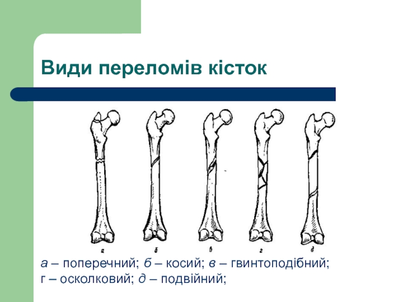 Виды переломов картинки