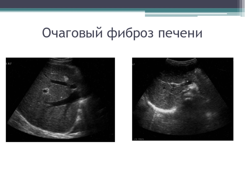 Кардиальный фиброз. Участки фиброза печени на УЗИ. Фиброзные изменения в печени на УЗИ. Перипортальный фиброз УЗИ.