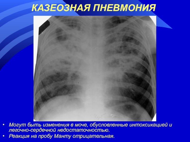 Казеозная пневмония презентация