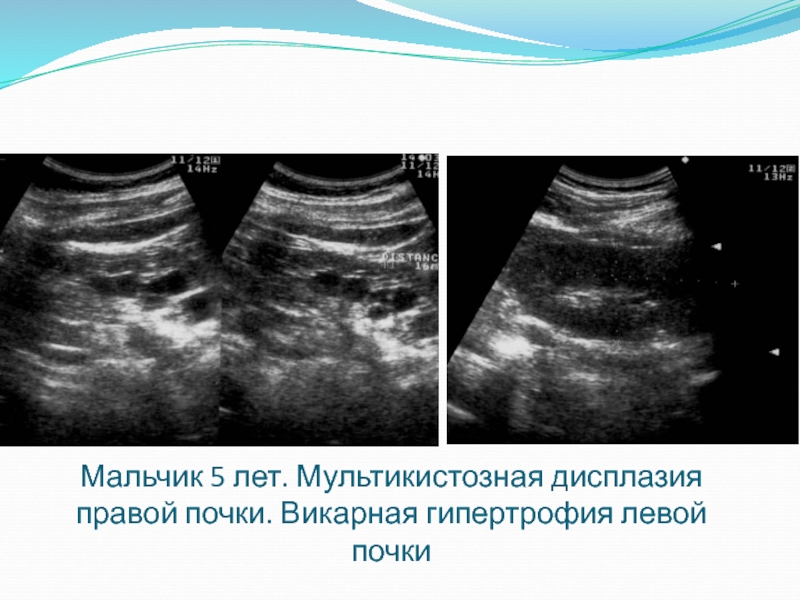 Дисплазия почки презентация