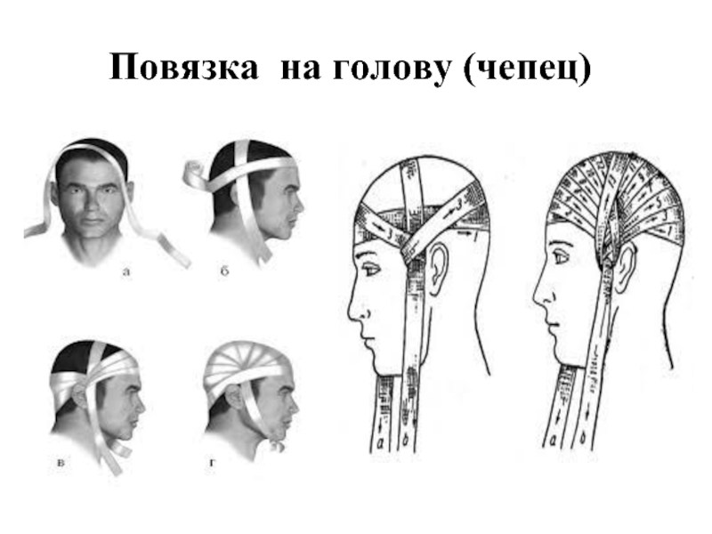 Схема наложения повязки чепец