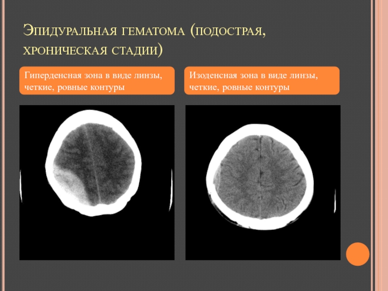 Гиперденсные структуры на кт изображениях