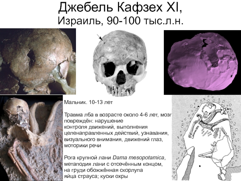 Антропогенез часть 18 пре-палеоантропы и палеоантропы Африки и Ближнего Джебель Кафзех XI, Израиль, 90-100 тыс.л.н.Мальчик. 10-13 летТравма лба в возрасте Джебель Кафзех XI, Израиль, 90-100 тыс.л.н.Мальчик. 10-13 летТравма лба в возрасте около 4-6 лет, мозг повреждён: нарушениеконтроля