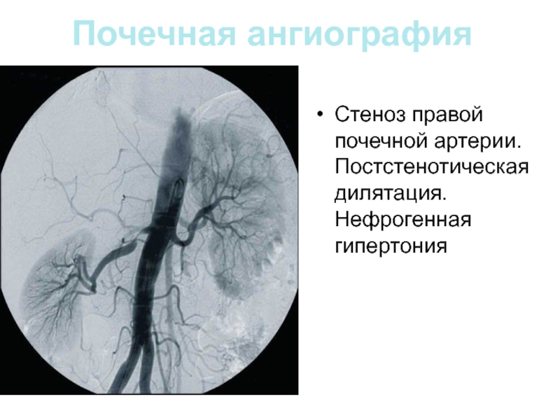 Тромбоз почечной артерии. Селективная церебральная ангиография. Кт ангиография почечных артерий. Артериография почечных артерий. Аортография почечных артерий.
