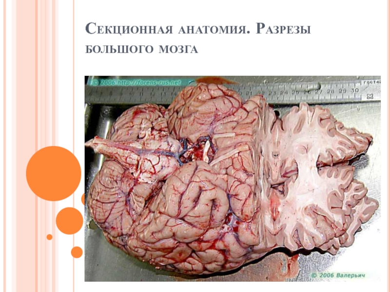 Секционная анатомия. Разрезы большого мозга