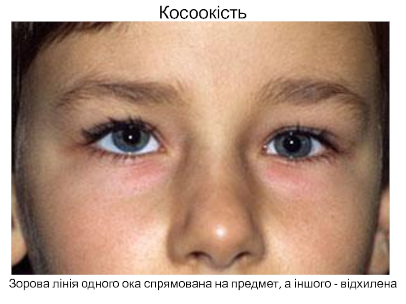 Косит глаз причины. Паралитическое вертикальное косоглазие. Гетерофория глаза. Косоглазие у детей.