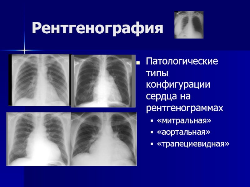 Конфигурация сердца аортальная схема