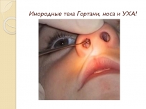 Инородные тела Гортани, носа и УХА