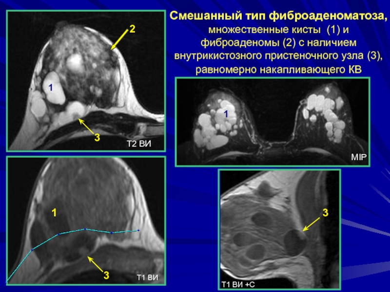 Лучевая диагностика заболеваний молочных желез презентация