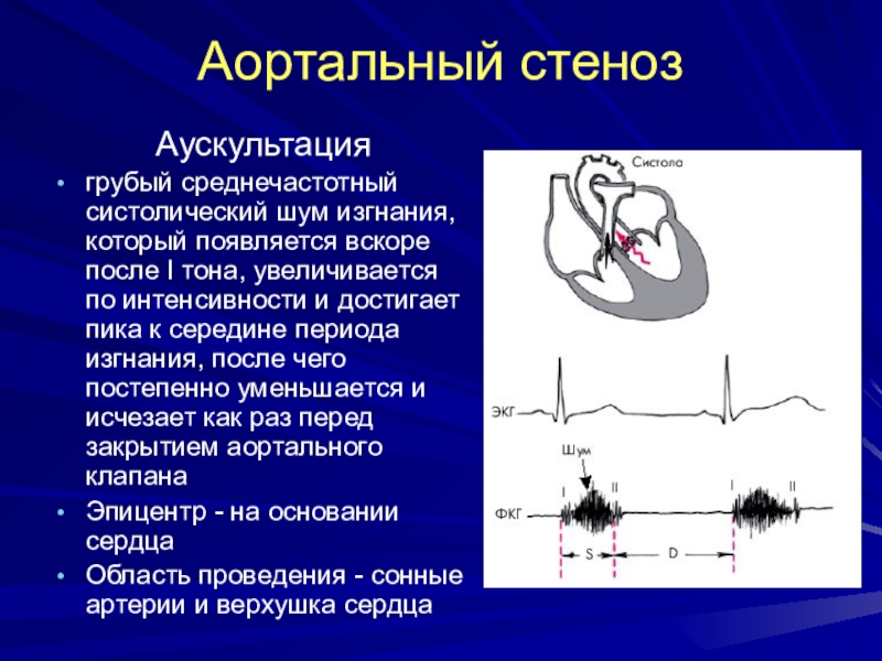 1 тон сердца. Аускультативная картина при стенозе аортального клапана. Аускультация при аортальном стенозе. Аускультация при стенозе аортального клапана. Шум при стенозе аортального клапана.