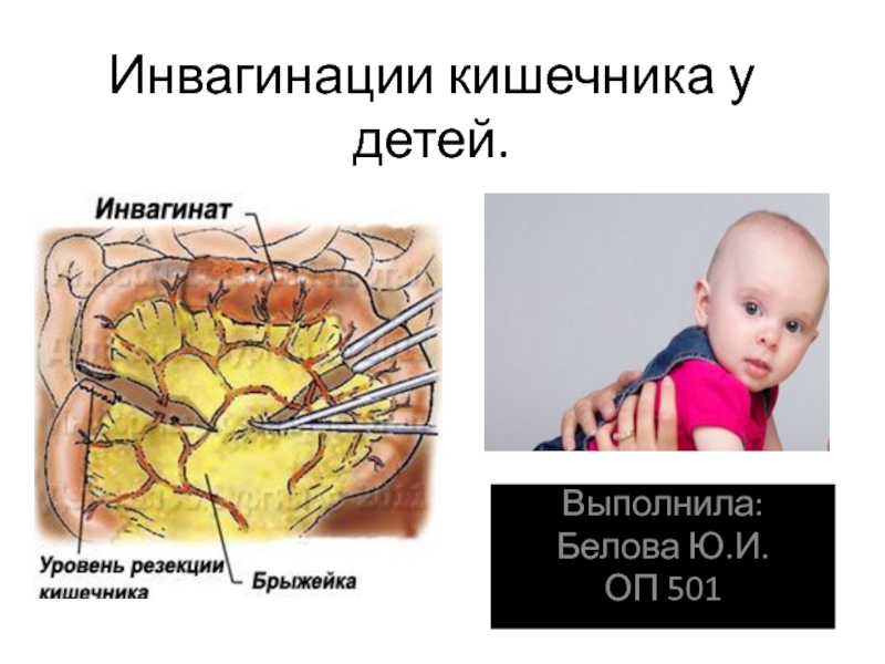 Инвагинации кишечника у детей