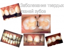 Заболевания твердых тканей зубов 