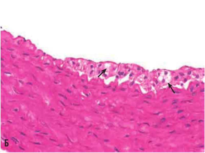 Микроскопическая картина атеросклероза аорты