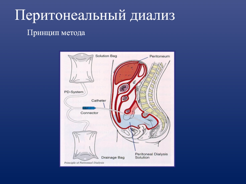 Перитонеальный диализ схема