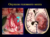 Опухоли головного мозга  