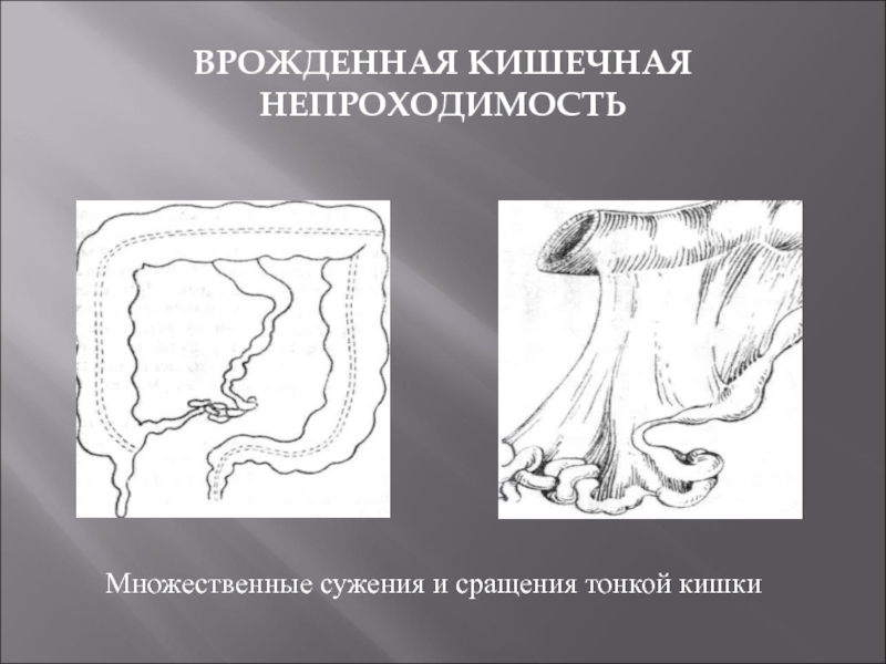 Врожденная кишечная непроходимость презентация