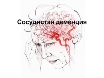 Сосудистая деменция