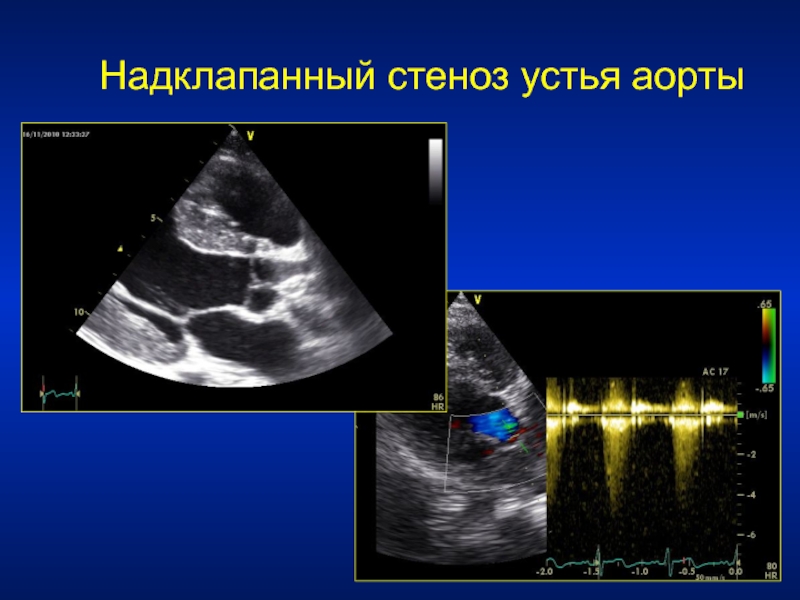 Двустворчатый аортальный клапан классификация