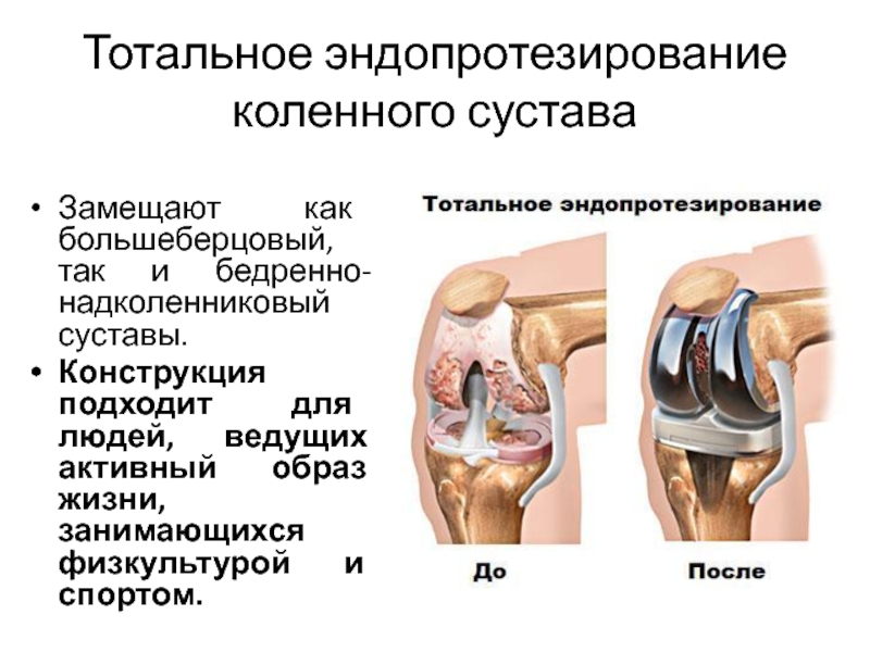 Замена коленного сустава картинка