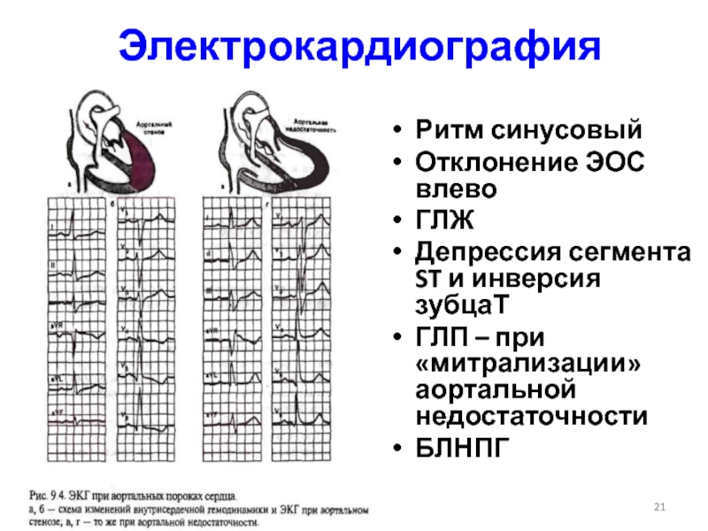 Отклонение эос влево