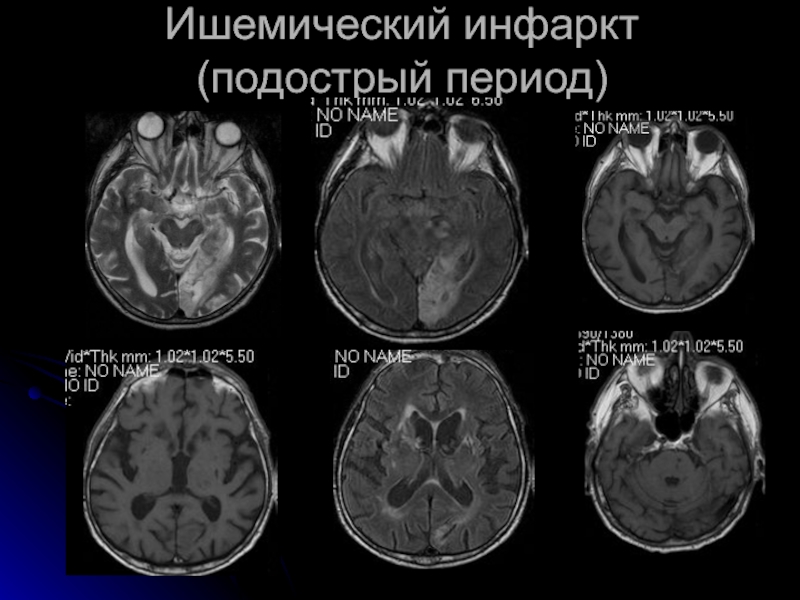 Инсульт левого полушария головного. Классификация сосудистых мальформаций головного мозга.